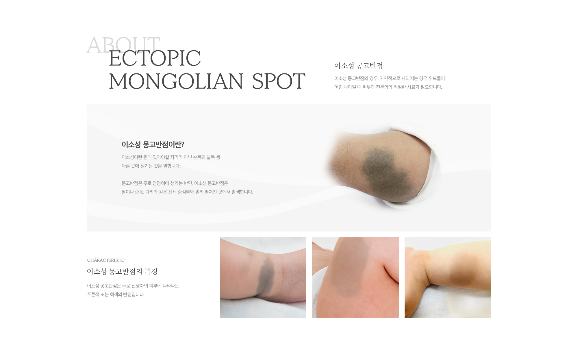 이소성 몽고반점